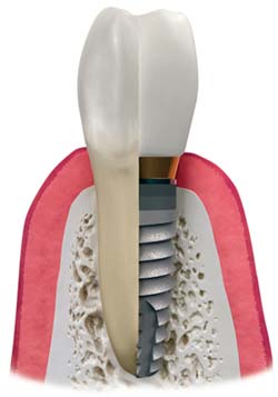 Learn what a dental implant is and how it helps you achieve a natural smile again