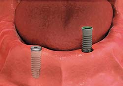 Dental implants provide a better solution for missing teeth than dentures