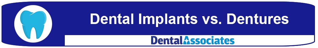 Implants Versus Dentures