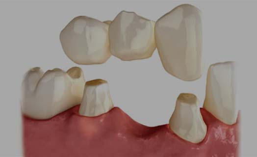 Learn about dental bridges.