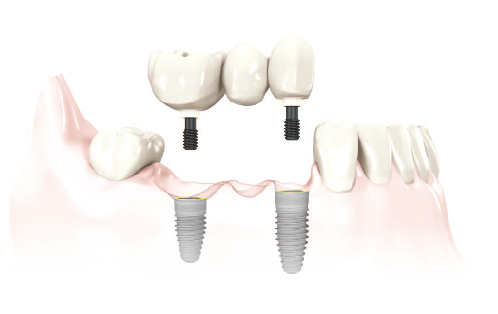 Dental implants for multiple missing teeth preserve the integrity of the bone as well as remaining teeth around the missing teeth.