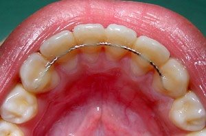 Fixed lingual retainers are permanent retainers and comfortable to wear