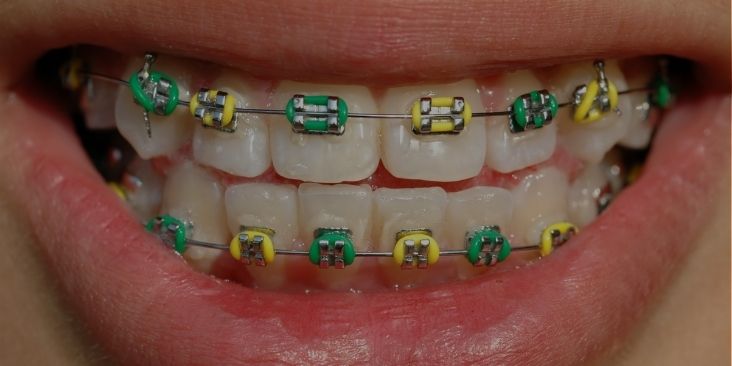 Learn about colored bands for traditional metal braces.