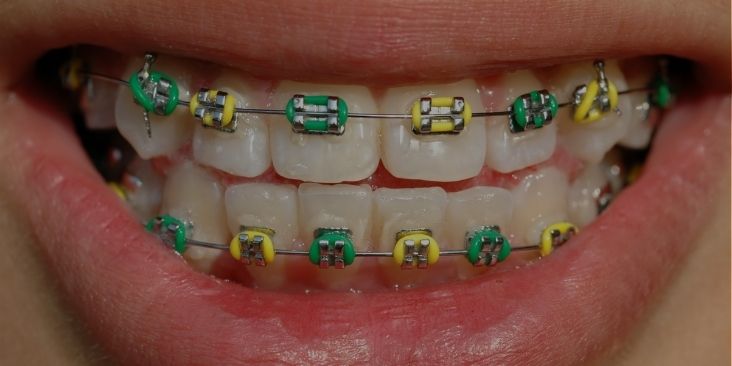 Traditional Braces