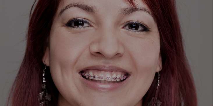 Can adults get braces? Read this blog post to find out.