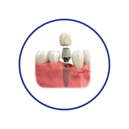 All dental implant treatment options 