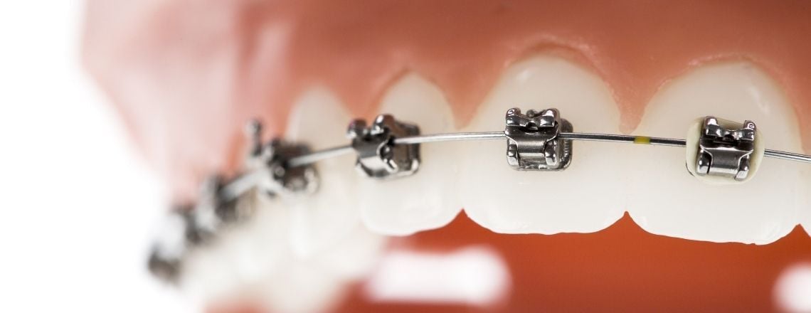close up of straight teeth with brackets and wire from braces