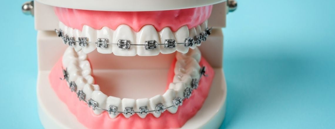 model of teeth with braces on them