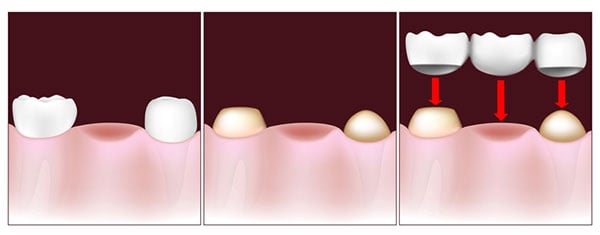 A dental bridge connects the gap where one or more teeth used to be