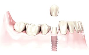 single-tooth-implant