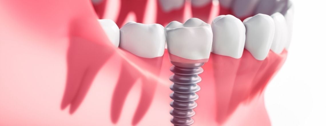 illustration of dental implant in a gumline