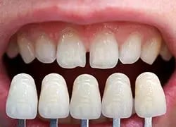 dental-veneers