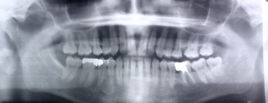 dental x-ray image showing teeth