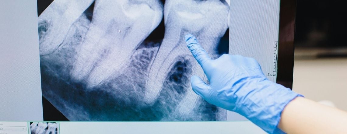 A dentist pointing to a dental X-ray on a computer screen showing tooth roots.