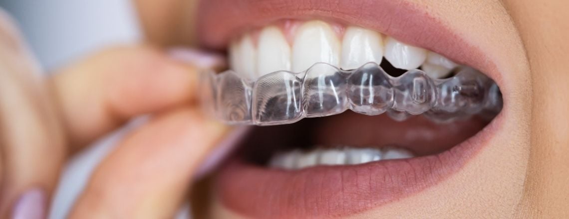 close up of woman's mouth who is holding a clear aligner tray and putting it in her mouth