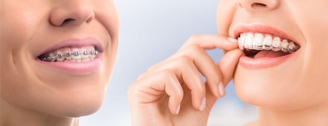woman with braces on the left and different woman with invisalign clear aligners on the right