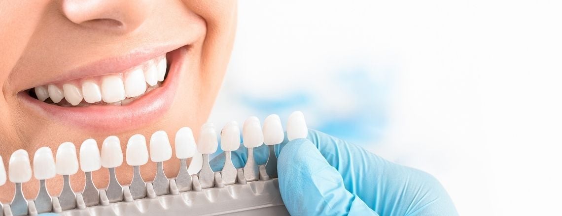 Dentist holding a dental shade guide next to a patient's smile to select the perfect tooth color.