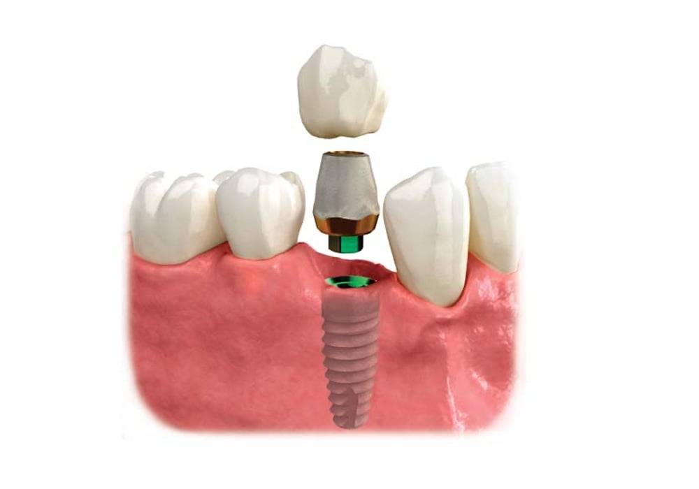 Dental implant for missing one tooth.