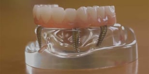 same-day-dental-implants