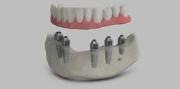 teeth-xpress-dental-implants