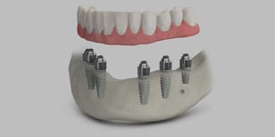 teeth-xpress-dental-implants