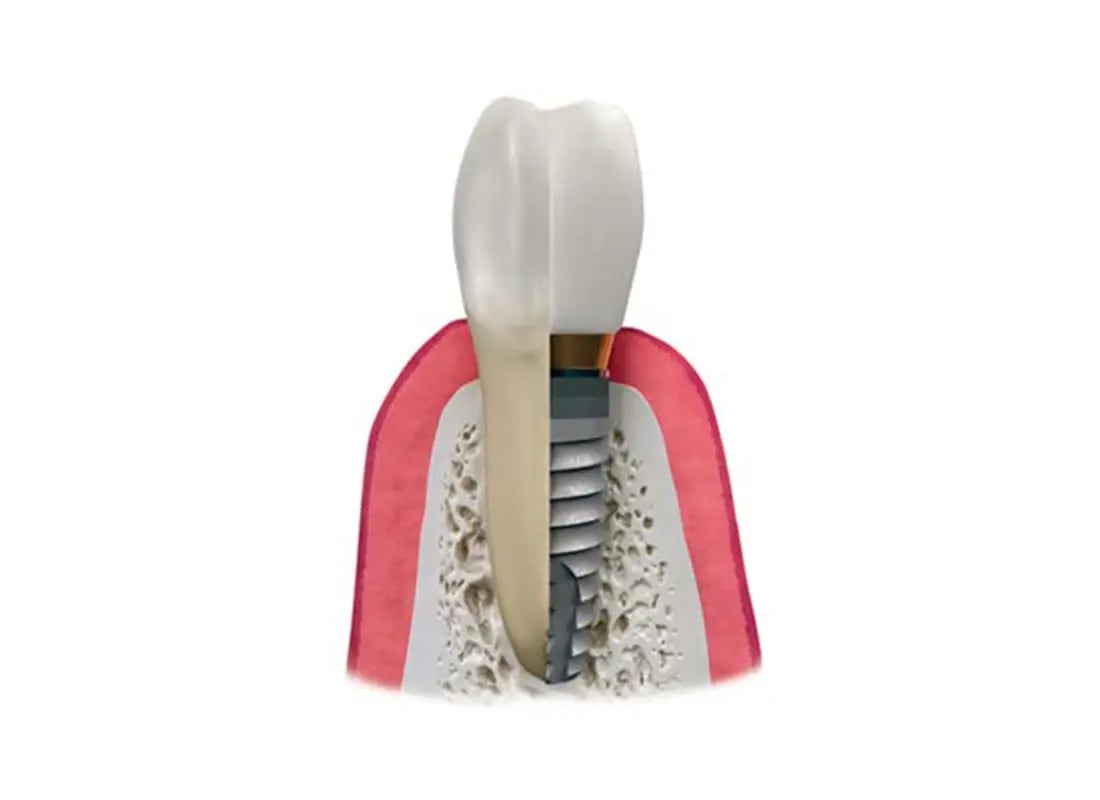 Diagram showing a dental implant post in the jawbone supporting a crown next to a natural tooth root