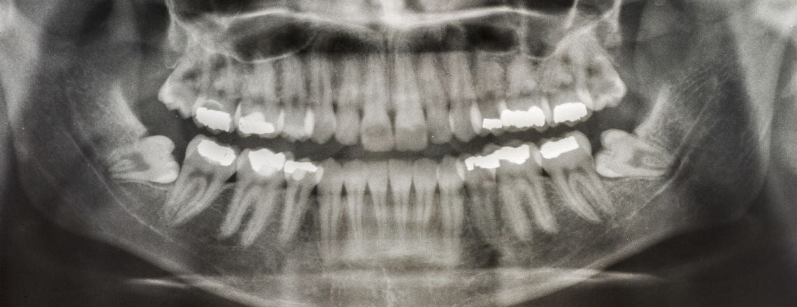 x-ray image highlighting wisdom teeth