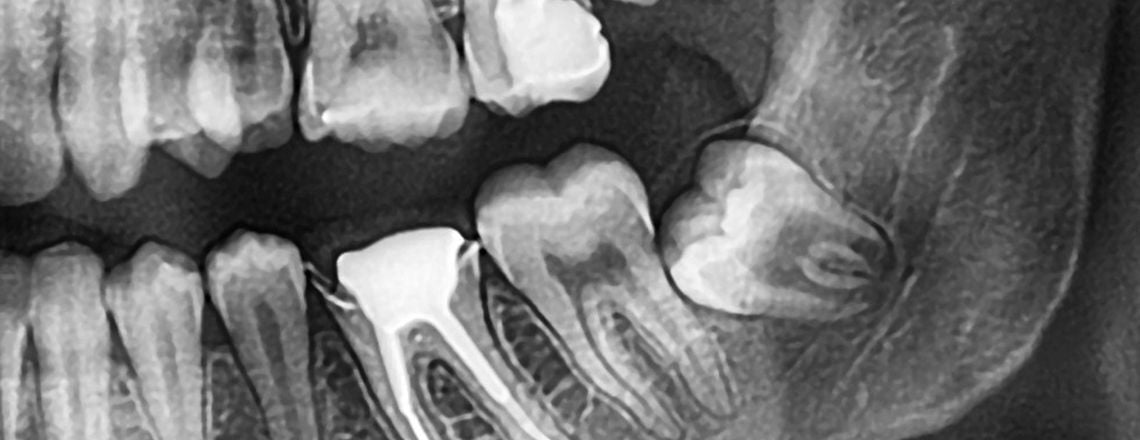 X-ray image showing wisdom teeth