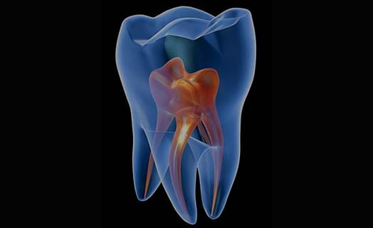 dental-fillings-root-canal