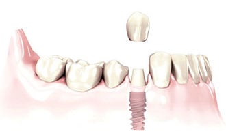 A single-tooth implant replaces a missing tooth and preserves the bone integrity to prevent further deterioration. 