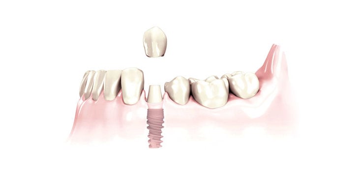 dental-implant-procedures