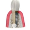 replacing-your-dentures